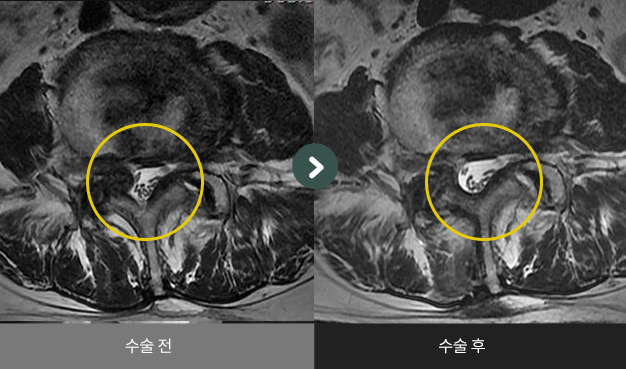 양방향 척추내시경(추간공 확장술) 수술 전 > 수술 후 비교2