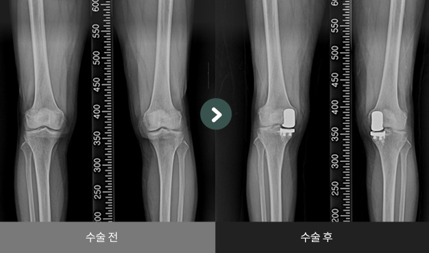 무릎 인공관절 반치환술 수술 전 > 수술 후 비교2