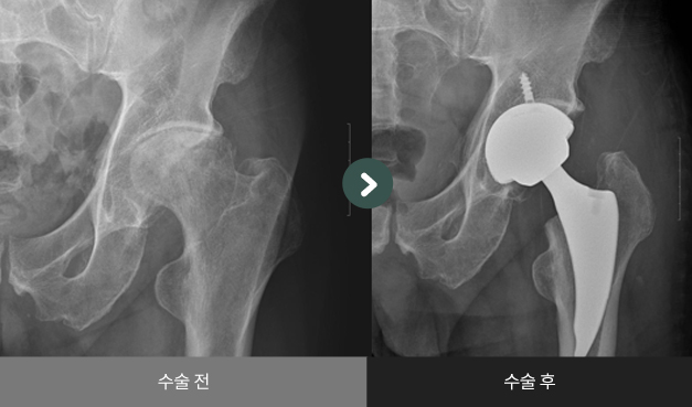 고관절 인공관절 전치환술 수술 전 > 수술 후 비교