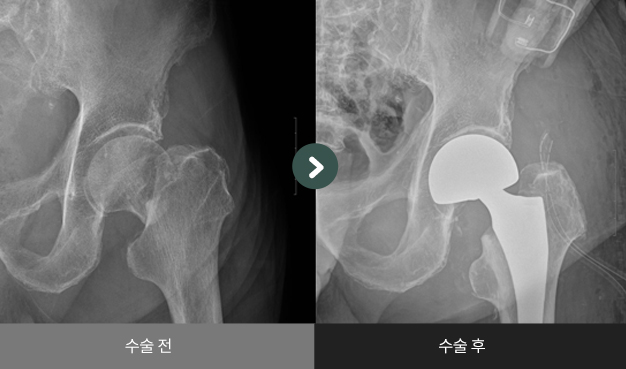고관절 인공관절 반치환술 수술 전 > 수술 후 비교2