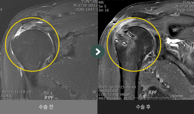 관절와순봉합술 및 극상건 봉합술 수술 전 > 수술 후 비교2