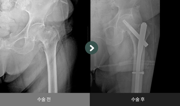 좌측 대퇴전자부 골절 수술 전 > 후